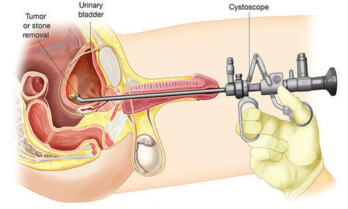 Â Best Laser Surgery for Prostate