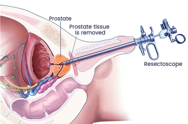 PROSTATE LASER SURGERY